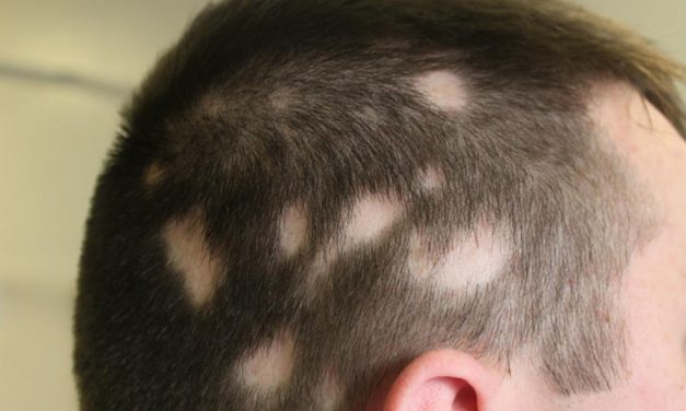 Le alopecie cicatrizzali