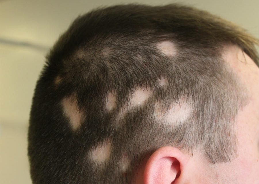 Le alopecie cicatrizzali