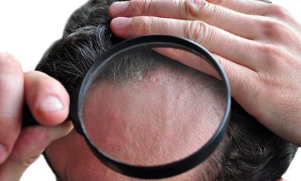 L’alopecia psoriasica, che cosa è?
