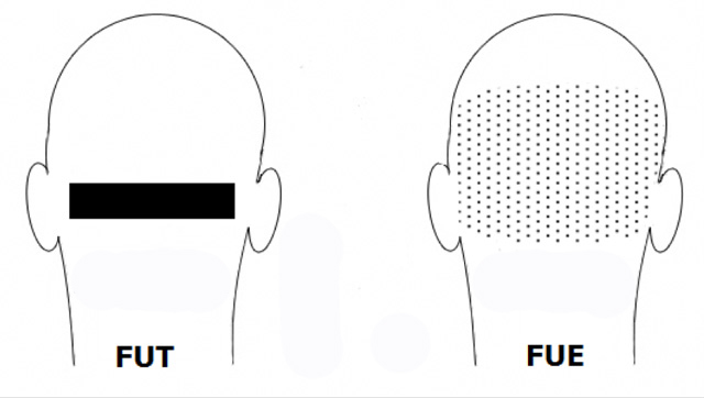 Differenza tra tecnica FUE e FUT