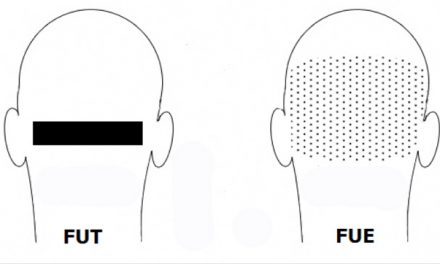 Autotrapianto di capelli: differenze tra FUT e FUE