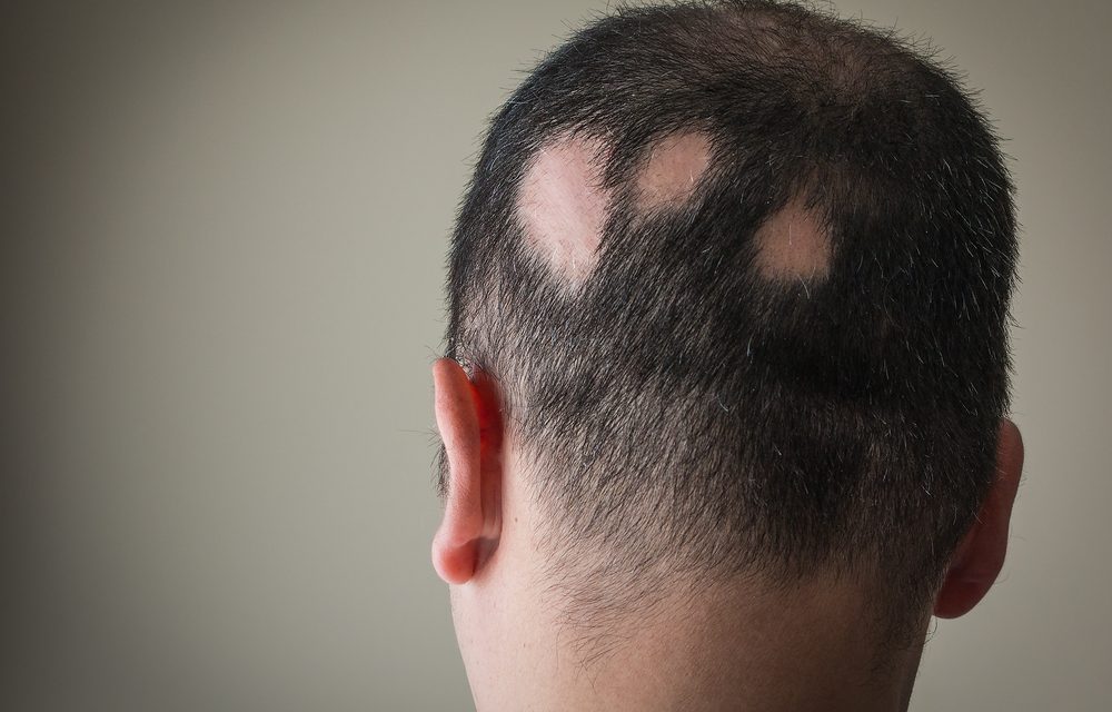 Alopecia – ne soffre un italiano su tre