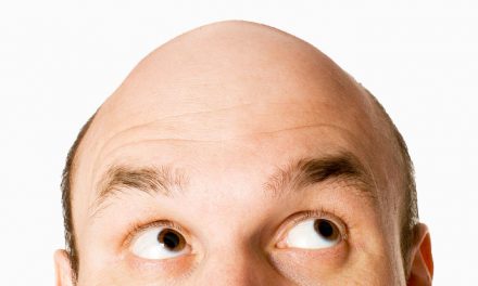 Calvizie – le origini del trapianto di capelli