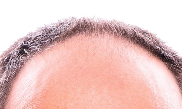 L’alopecia fronto-parietale maschile
