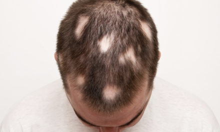 Alopecia – Tutti i tipi