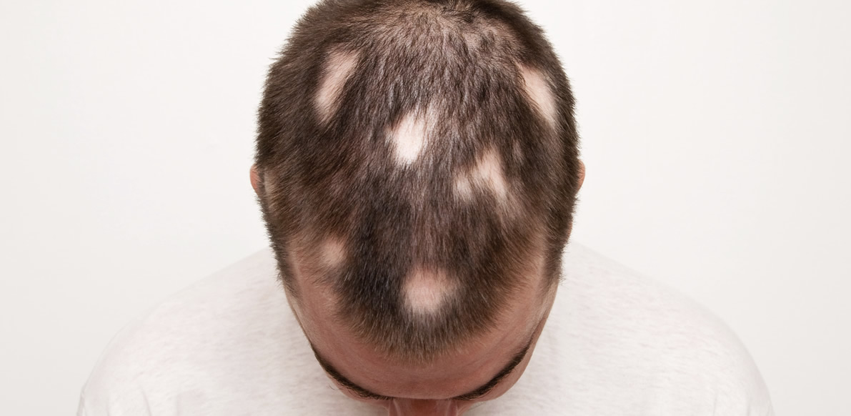 Alopecia – Tutti i tipi