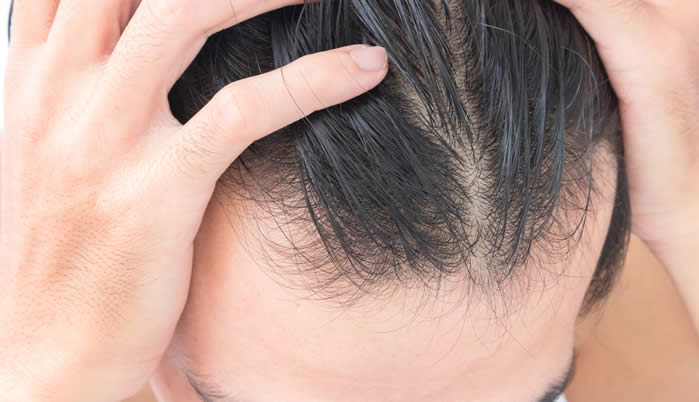 Alopecia androgenetica