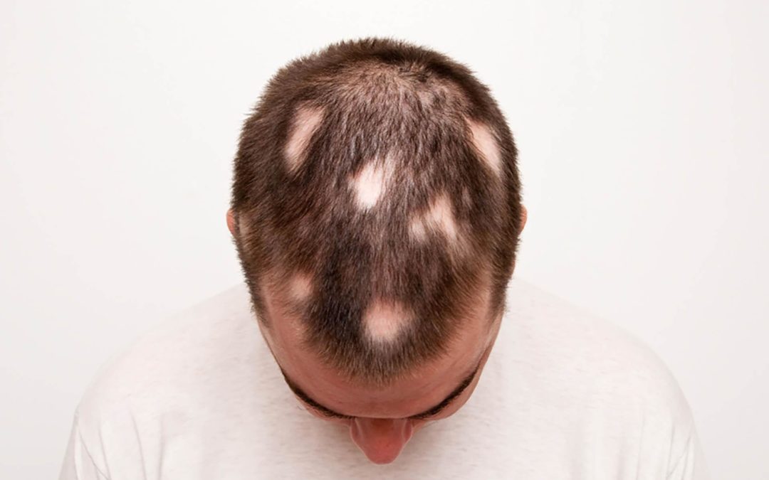 Tricotillomania