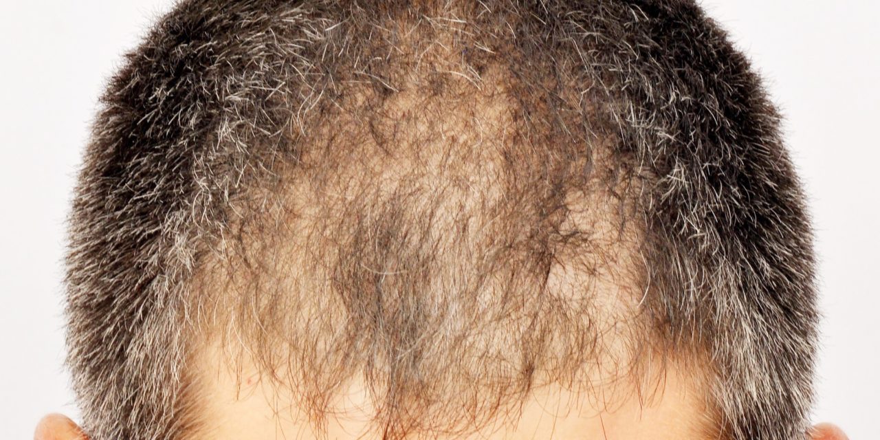 Alopecia da ustione – trapianto capelli