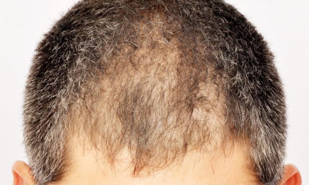 Alopecia da ustione – trapianto capelli