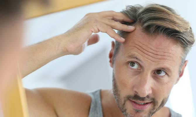 Calvizie, 5 tipi di alopecia