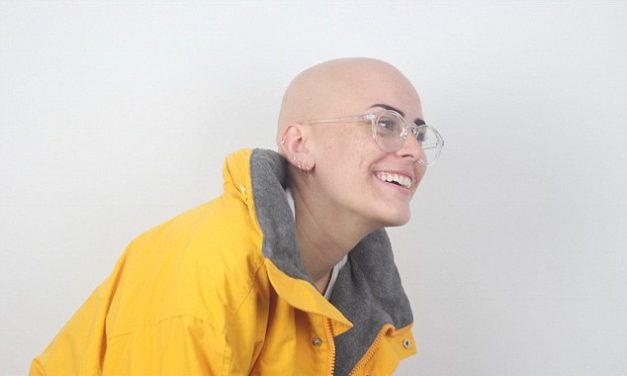 Sarah Rose Meyers e l’alopecia universale