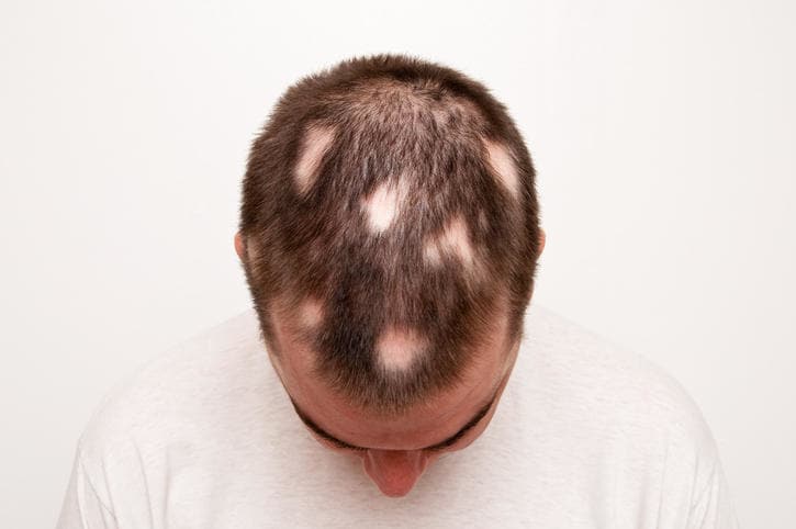 L’alopecia areata spia di altre malattie autoimmuni