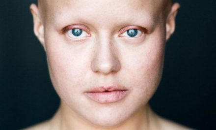 Caduta dei capelli – Alopecia Universale