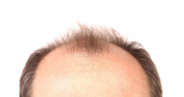 Le origini del trapianto di capelli