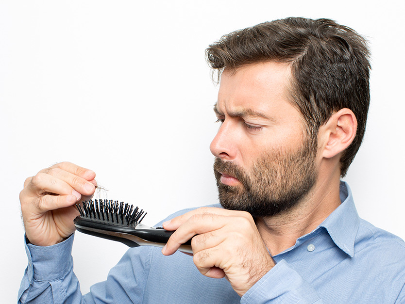 Perché gli uomini perdono i capelli?