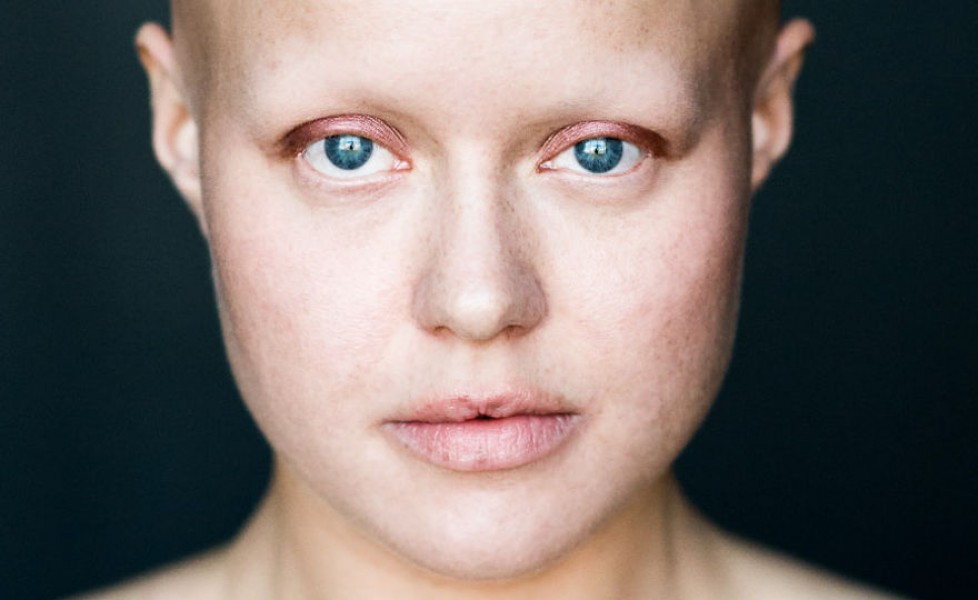 Caduta capelli – alopecia universale