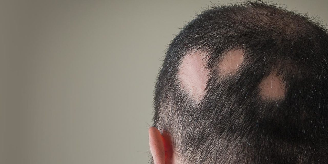 Alopecia cicatriziale