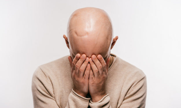 L’alopecia iatrogena – di cosa si tratta?
